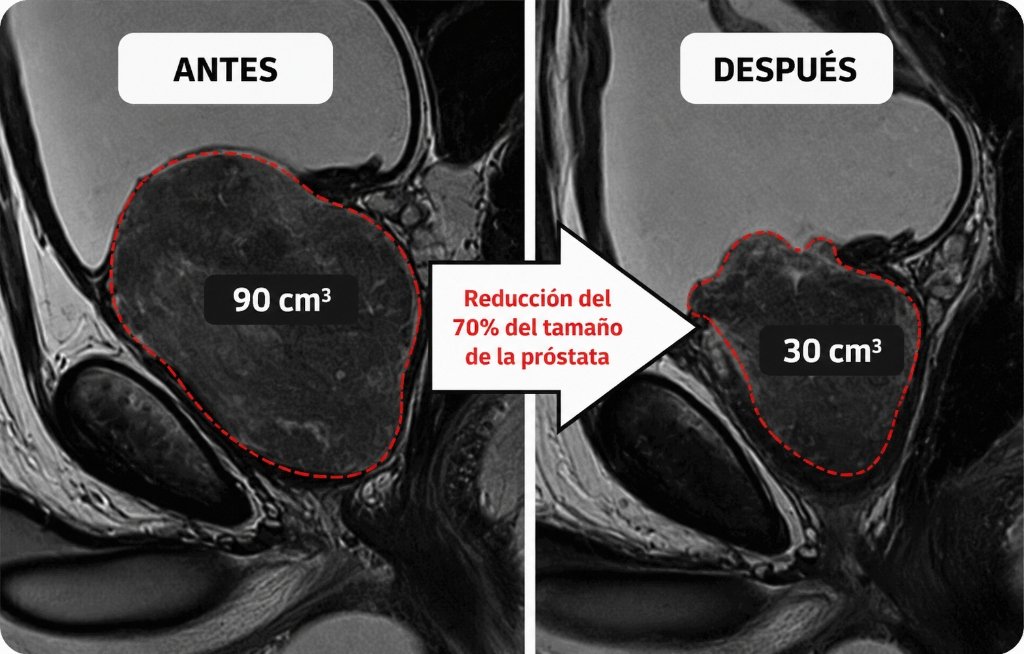 Comparación de Ecografía - Próstata Antes y Después